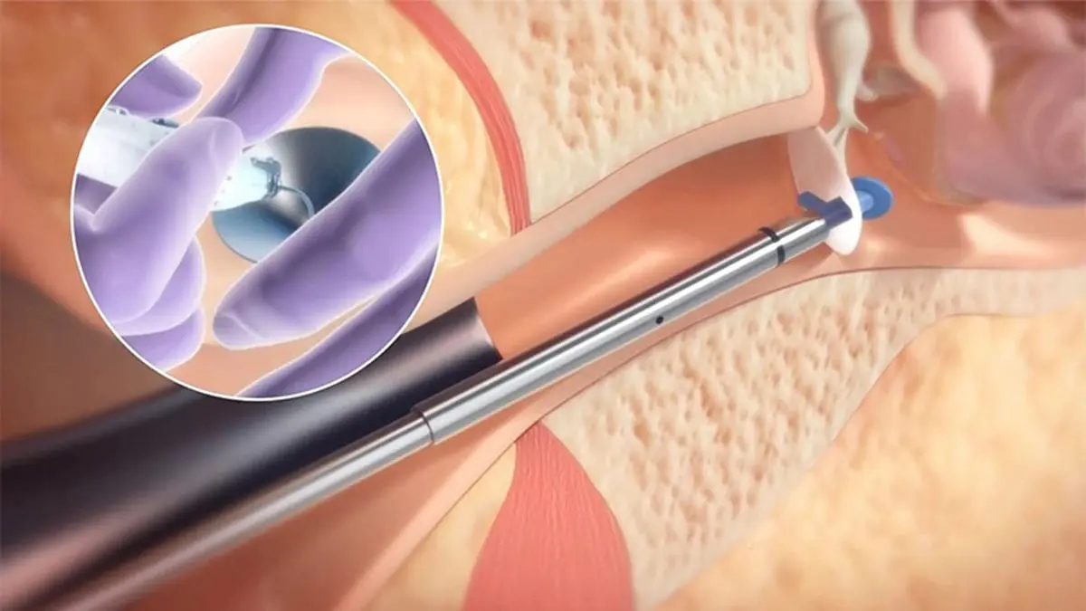 تقنية جديدة لإجراء عملية أنبوب الأذن للأطفال بعيدًا عن غرف العمليات