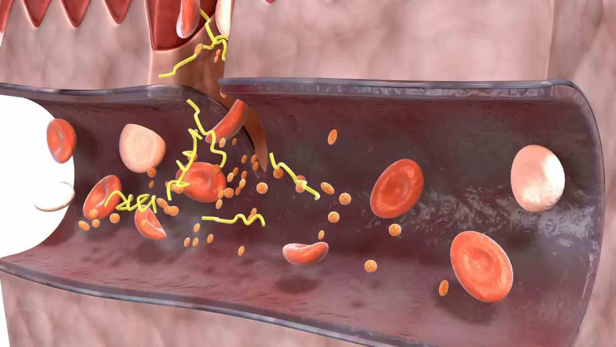 تقنية للتخلص من جلطات الدم بسرعة غير مسبوقة
