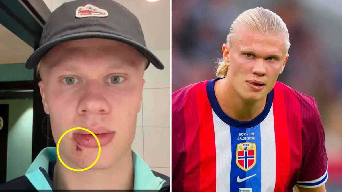 اصطدم بحافلة.. هالاند يتعرض لإصابة في وجهه (صور)