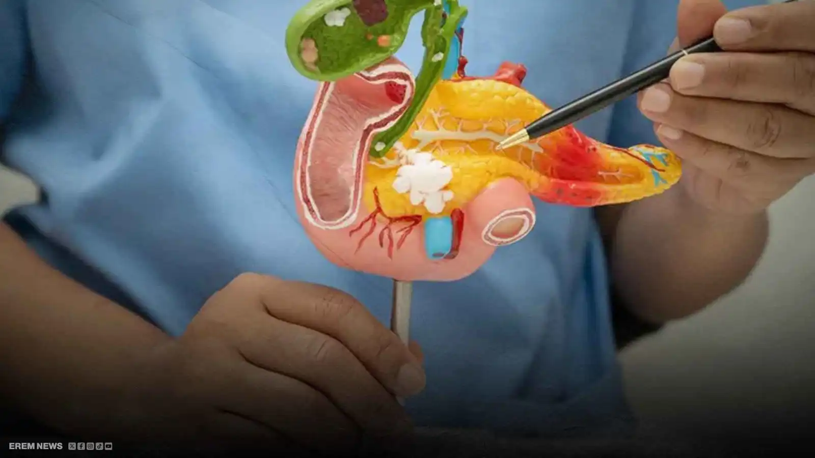 اختراق يهز عالم الطب.. أمل في معركة سرطان البنكرياس (فيديو إرم)