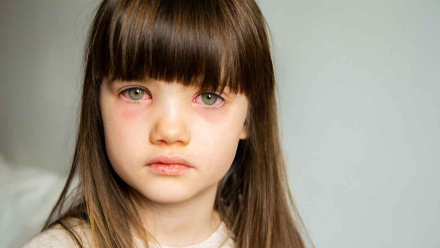 التهاب الملتحمة لدى الأطفال.. هل يستوجب غيابهم عن المدرسة؟