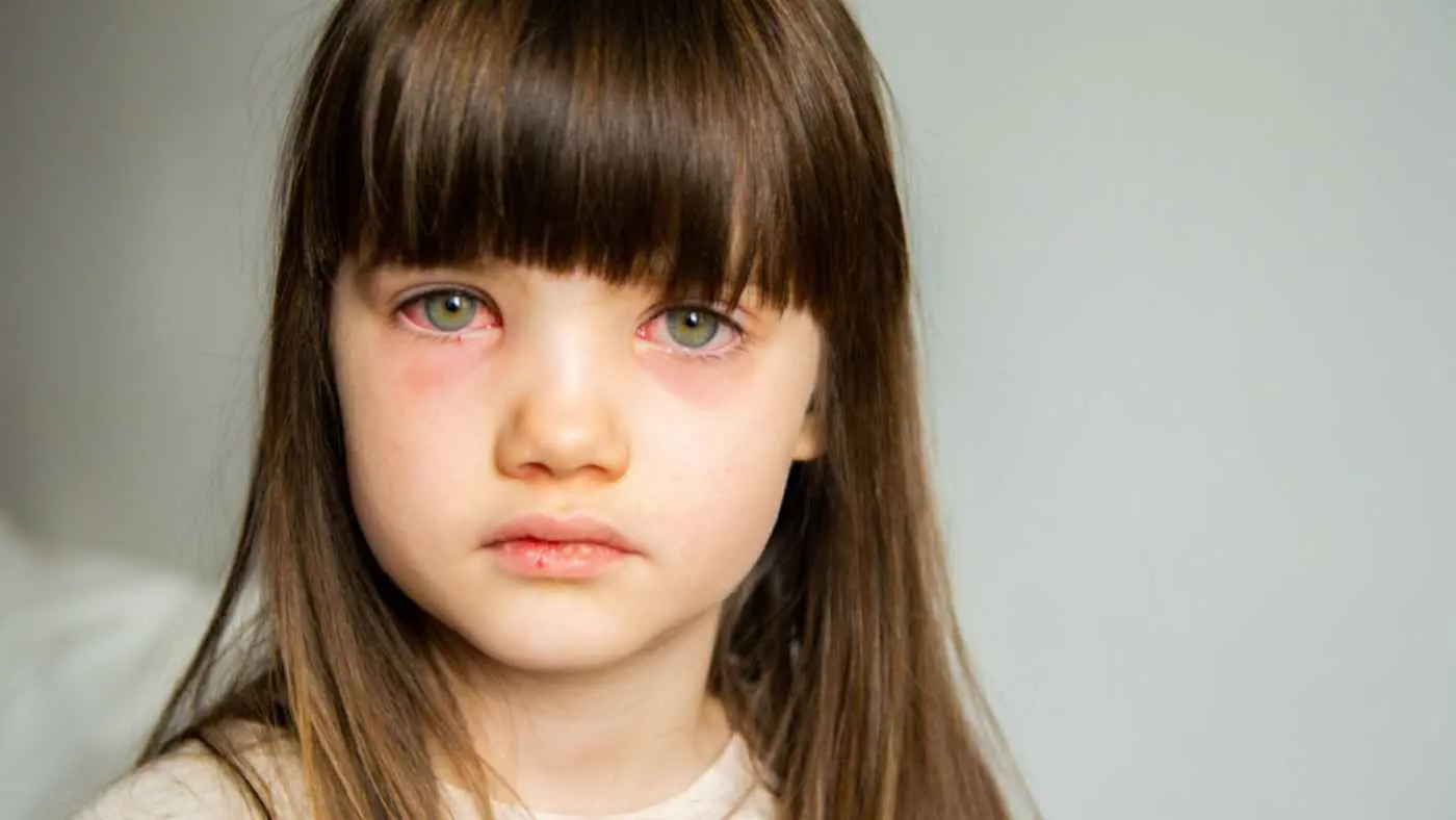 التهاب الملتحمة لدى الأطفال.. هل يستوجب غيابهم عن المدرسة؟