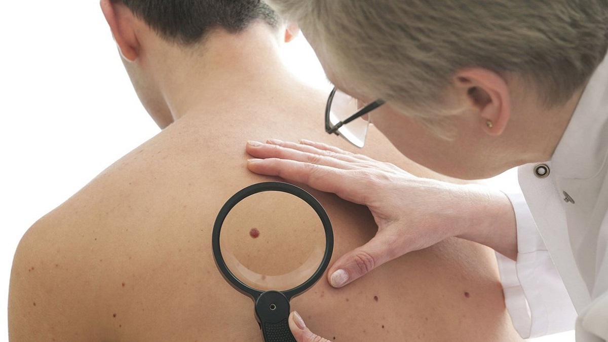 بينها الصدفية.. التوتر قد يسبب هذه المشاكل الجلدية