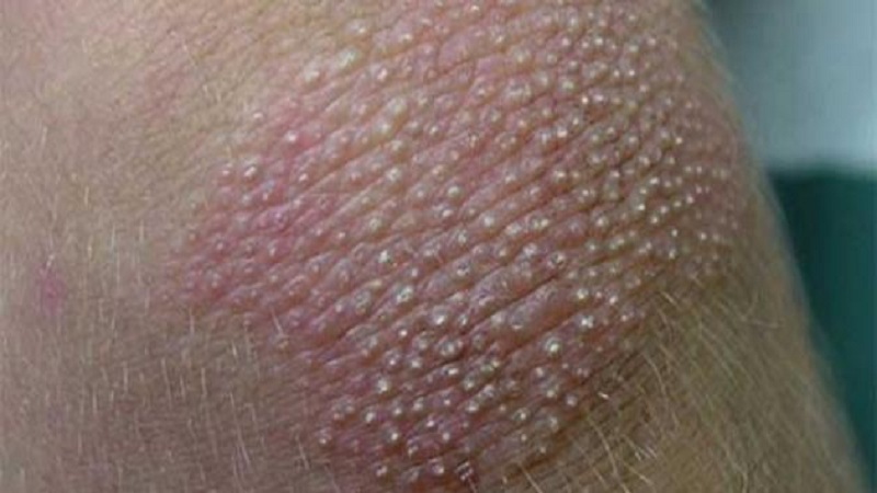 علاج سدادات الكيراتين أو "بشرة الدجاجة"