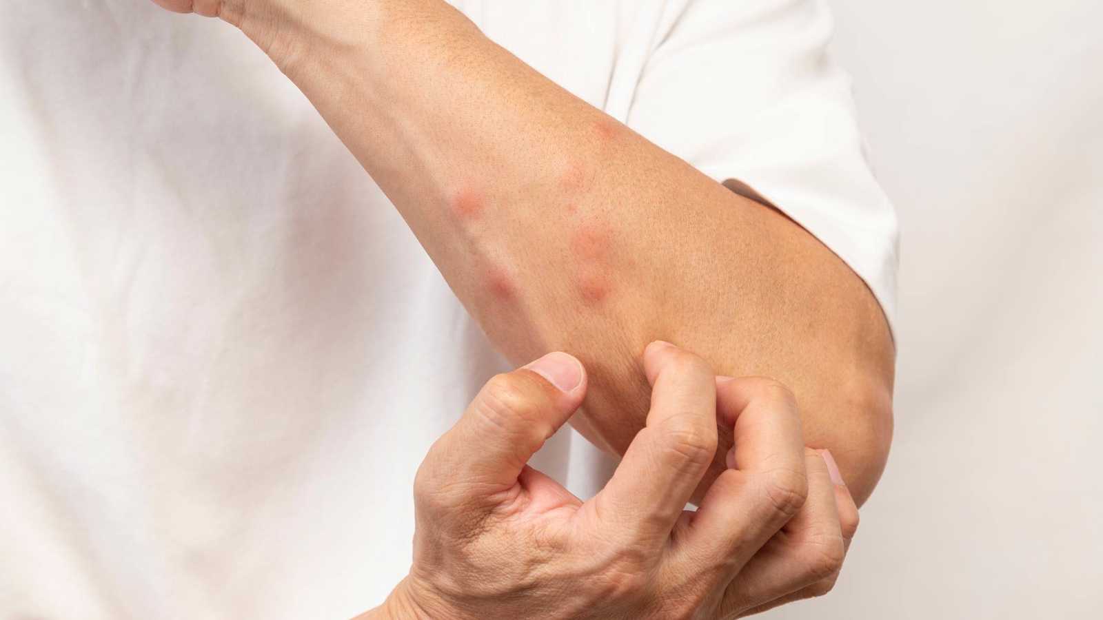 لماذا يعضك البعوض أكثر من الآخرين؟.. العلم يُجيب