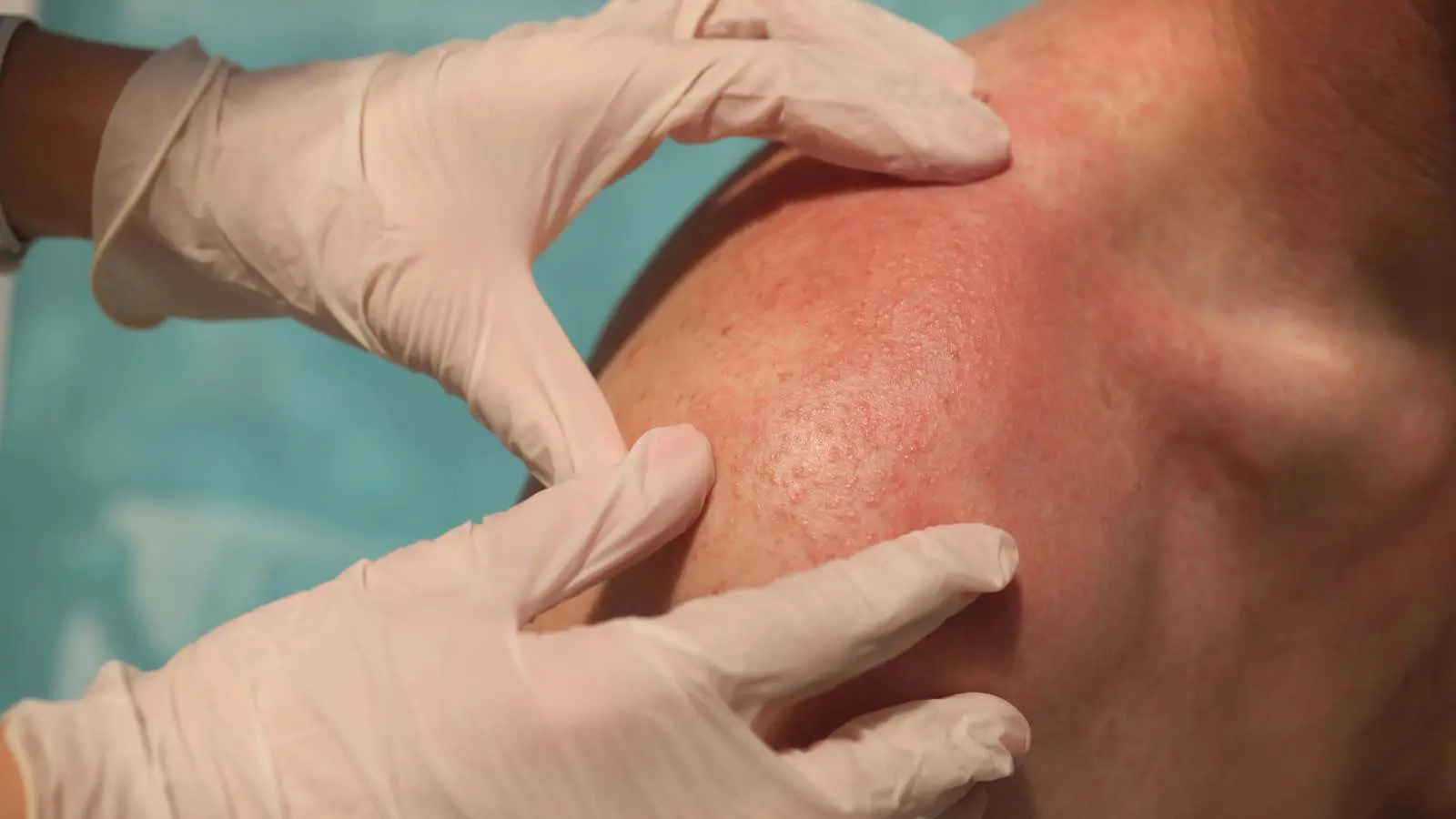 5 علاجات منزلية لتخفيف الحكة في فصل الصيف