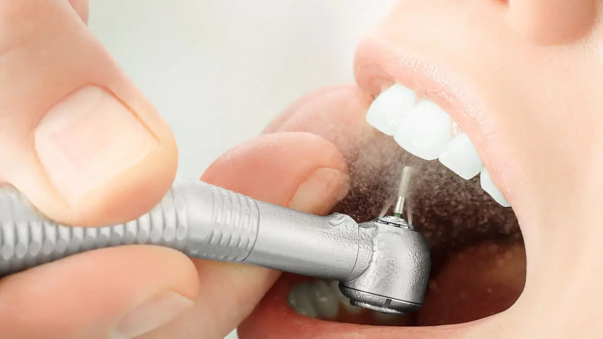 علاج جديد لحشو الأسنان بلا حفر
