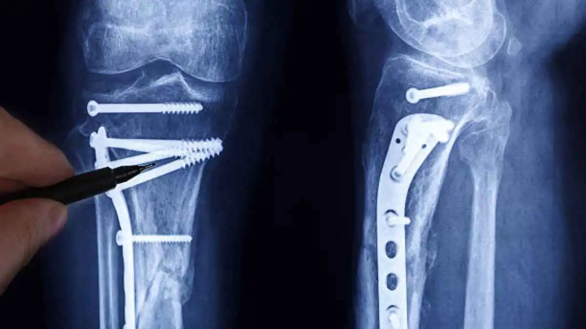 علماء روس يبتكرون براغي جراحية تُمتص داخل الجسم دون جراحة ثانية