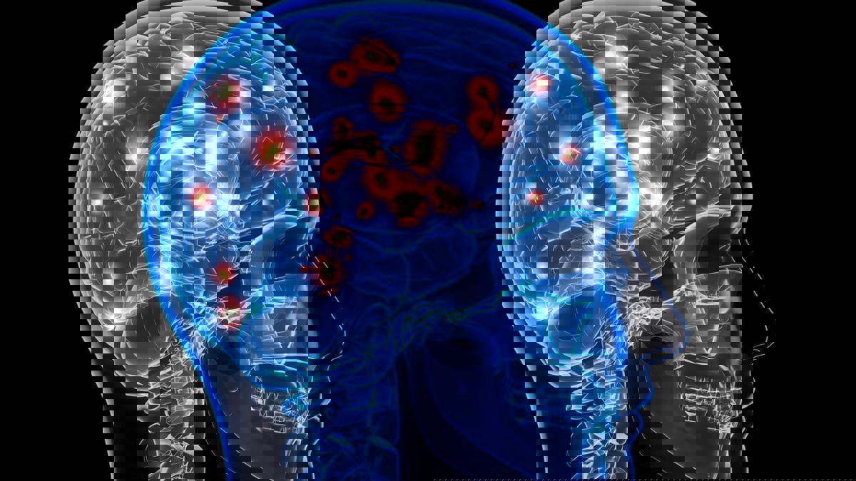 زرعة دماغية تترجم الأفكار إلى نص لمرضى الشلل