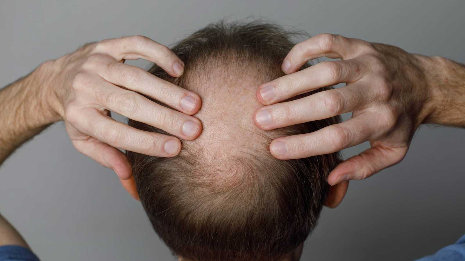 الصلع الوراثي عند الرجال قد يؤثر على القدرة الإنجابية