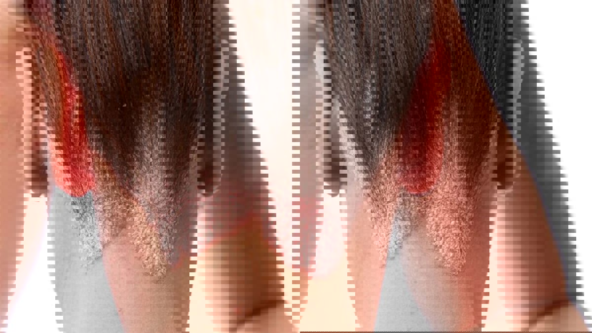  إلى مرضى الصدفية.. احذروا نقص هذا الفيتامين