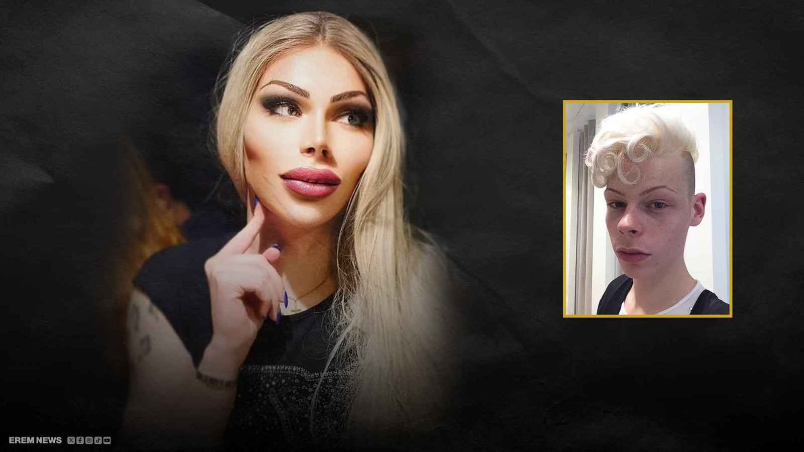 صاحب أكبر عظام وجنتين في العالم !!