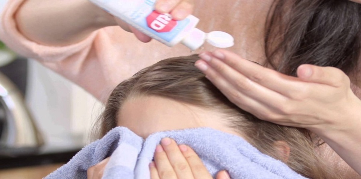 دراسة: المستحضرات الشائعة للتخلص من القمل لم تعد مجدية ‬