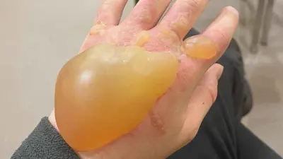 آثار البثور في جسم أحد الأشخاص