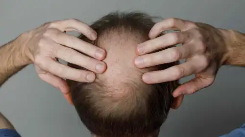 الصلع (تعبيرية)