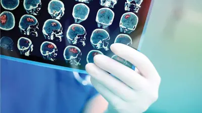 فحص السكتة الدماغية (تعبيرية)