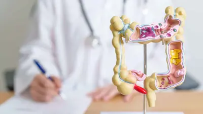 (سرطان القولون (تعبيرية