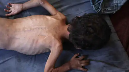 طفل من غزة يعاني من سوء التغذية