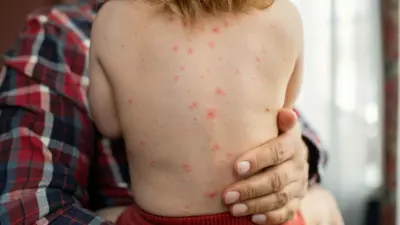 طفل مصاب بالحصبة 