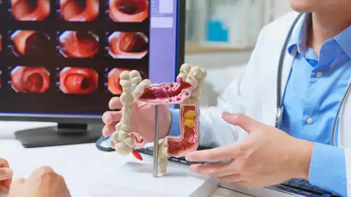 سرطان القولون - تعبيرية