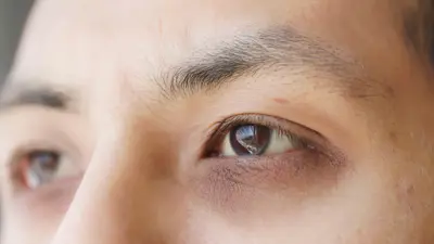 الهالات السوداء 