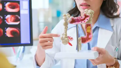 سرطان الأمعاء 