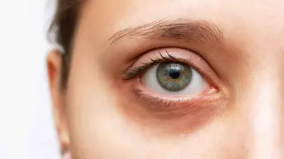 الهالات السوداء 