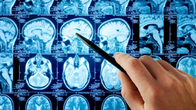 صور مقطعية لسرطان الدماغ 