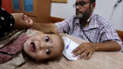 طفلة فلسطينية في غزة مصابة بفيروس شلل الأطفال