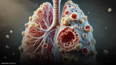 الـvape يحول الرئة إلى فشار