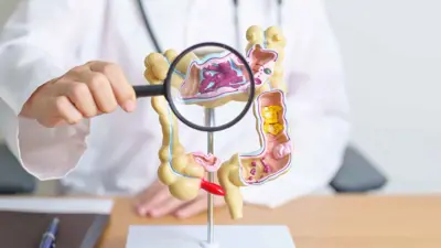 سرطان القولون 