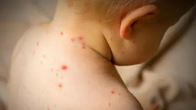 طفل يعاني من الحصبة 