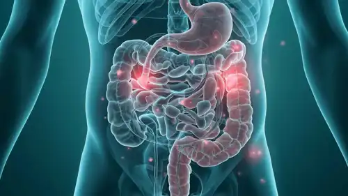 سرطان القولون