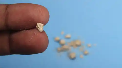 حصوات الكلى