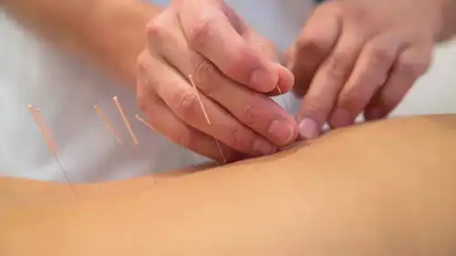 العلاج بالإبر الصينية 