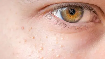 بثور على الوجه (تعبيرية)