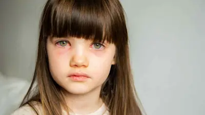 التهاب الملتحمة عند الأطفال