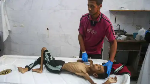 طفل من غزة فتك به الجوع