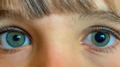 تأثير قطرة العين الموسعة على عين الطفل
